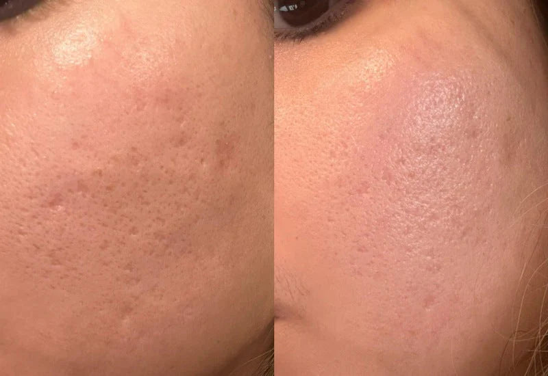 Tresiore microneedle infusion